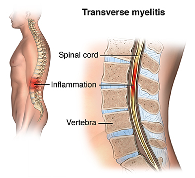 Acute transverse myelitis