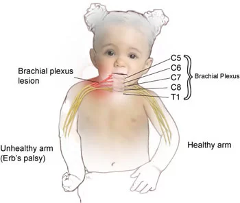 Erb’s Palsy & Physiotherapy Treatment: