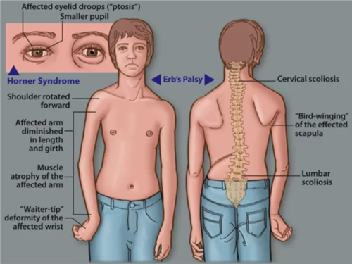 Erb’sPalsy Symptoms