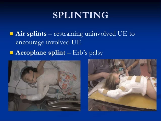 Splinting In Erb’s Palsy