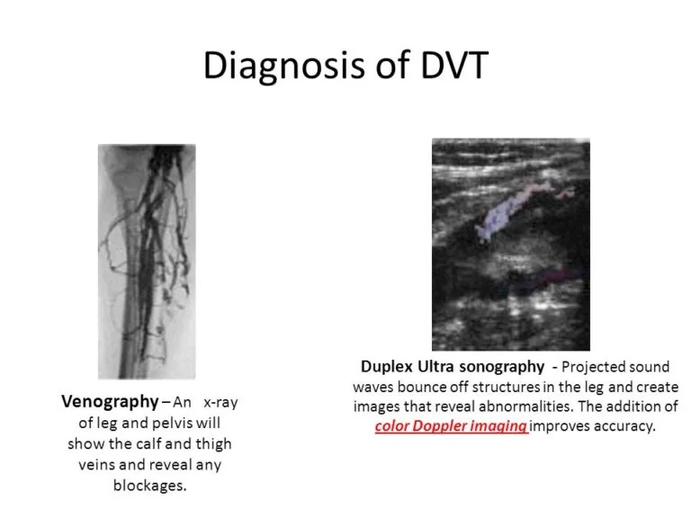 Diagnosis of DVT