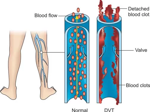 Distorted Blood Circulation in DVT