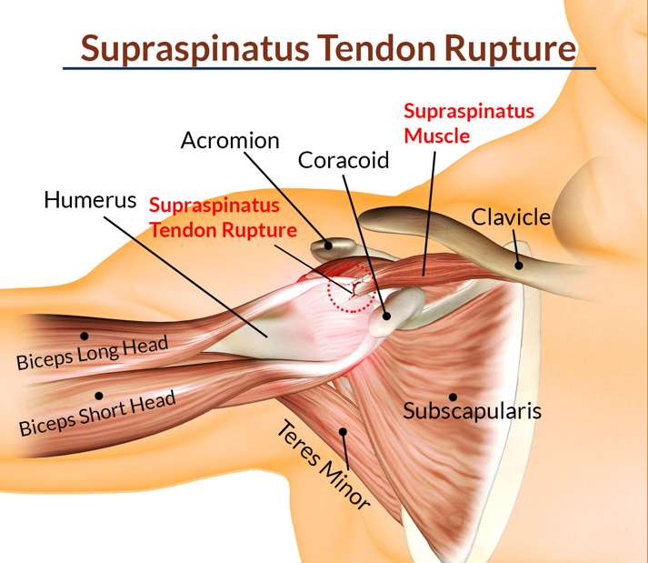 Supraspinatus Tendinitis Cause Sign Symptoms Physiotherapy Treatment