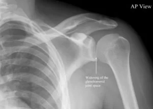 X-RAY of dislocated Shoulder