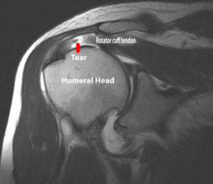 Rotator Cuff Injuries: Physiotherapy Treatment, Exercise