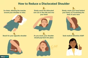 treatment of shoulder dislocation