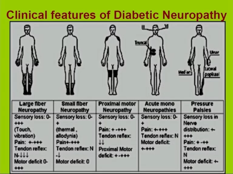 Classification of Diabetic Neuropathy