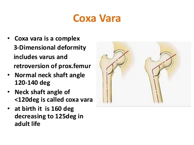 Congenital Coxa Vara