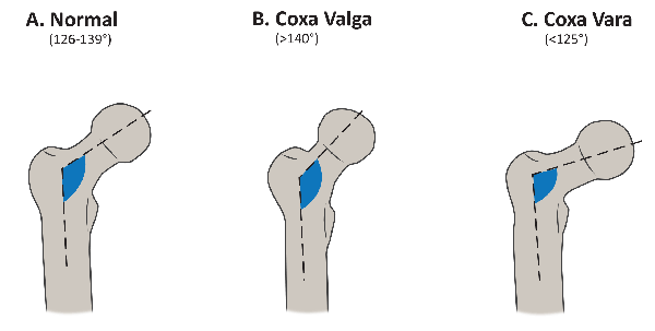 Coxa Vara: Deformity in Hip Joint