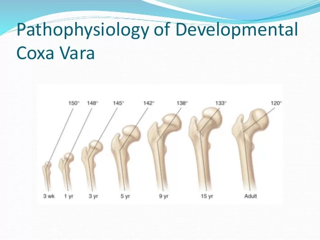 Developmental Coxa Vara