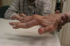 Hand with Swan Neck Deformity