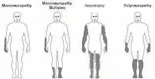 Mononeuropathy Polyneuropathy