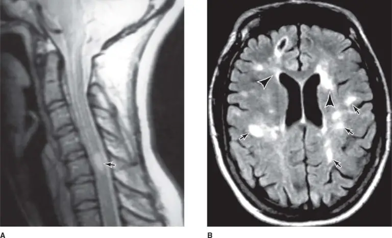 Peripheral neuropathy Diagnosis MRI