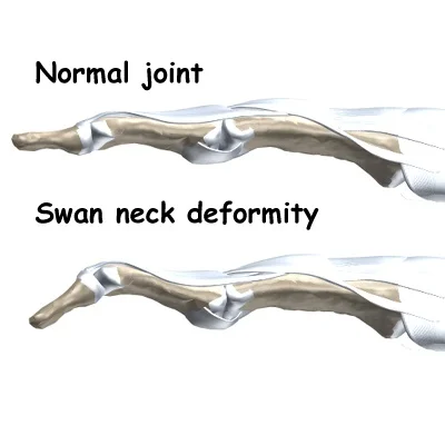 Swan Neck Deformity Diagnosis