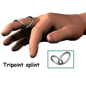 Tripoint Splint for Swan Neck Deformity