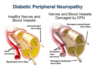 Diabetic Neuropathy: Physiotherapy Treatment