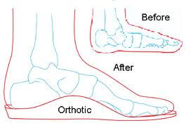Orthosis for Flat foot