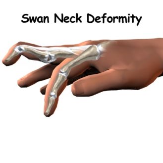 Swan Neck Deformity : Cause, Symptom, Diagnosis, Treatment