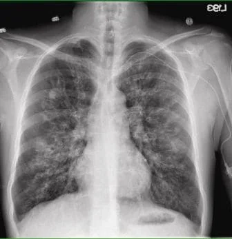 CHEST X-RAY IN CYSTIC FIBROSIS