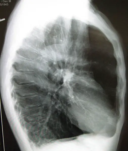 Emphysema Chest X-Ray