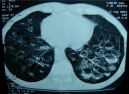 abnormal airway dilation of lung