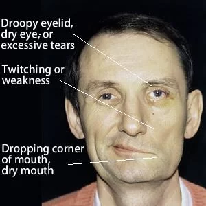 Facial Nerve Palsy