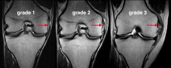 medial-collateral-ligament-grading-injury