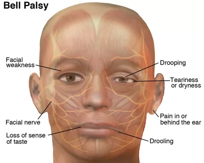 symptoms of Facial Palsy