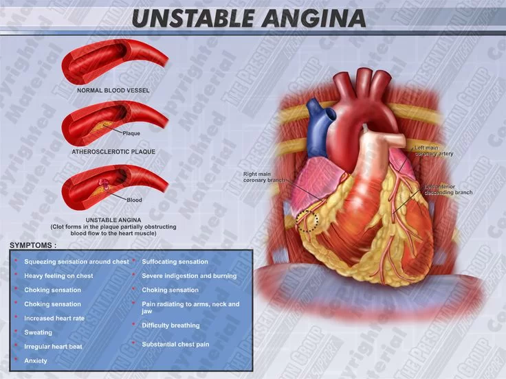 unstable angina