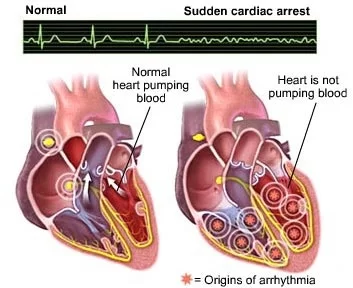 Cardiac-Arrest