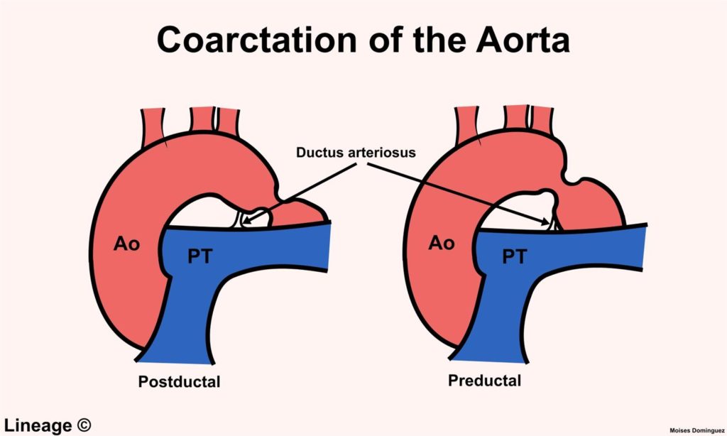coarctation of the aorta