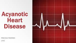 ACYANOTIC CONGENITAL HEART DISEASE