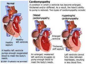 Cardiomyopathy: Causes, Symptoms, Diagnosis & Treatment