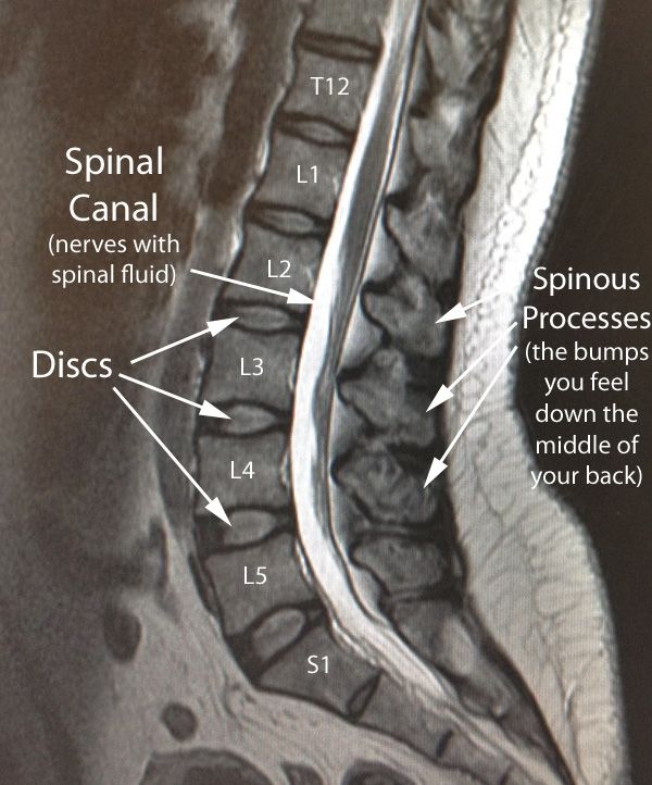 MRI in Low Back Pain