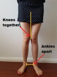 Varus Valgus Knee Deformity