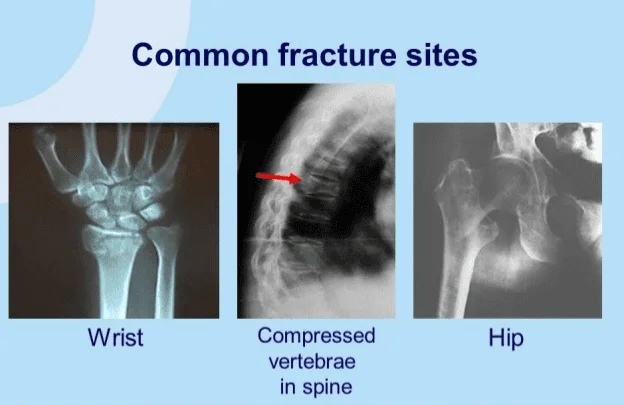 Osteoporosis X-ray image