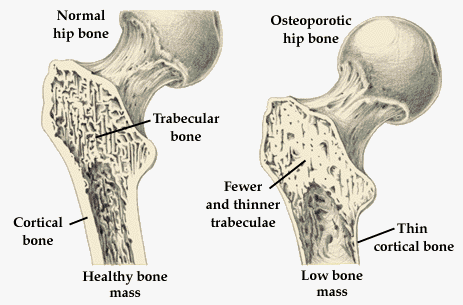 Normal And Osteoporotic Bone