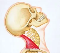 Hyperextension Neck