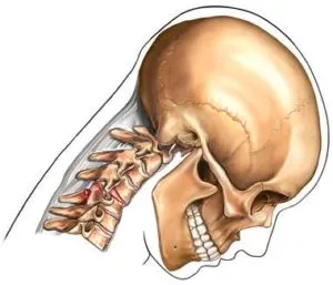 Hyperflexion Neck