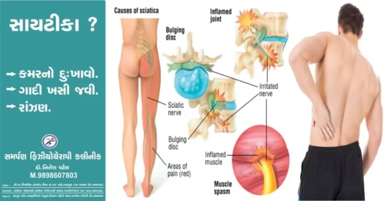 Sciatica Pain : Physiotherapy Treatment