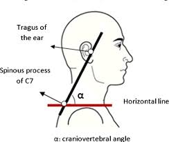 Craniovertebral Measurement Detail