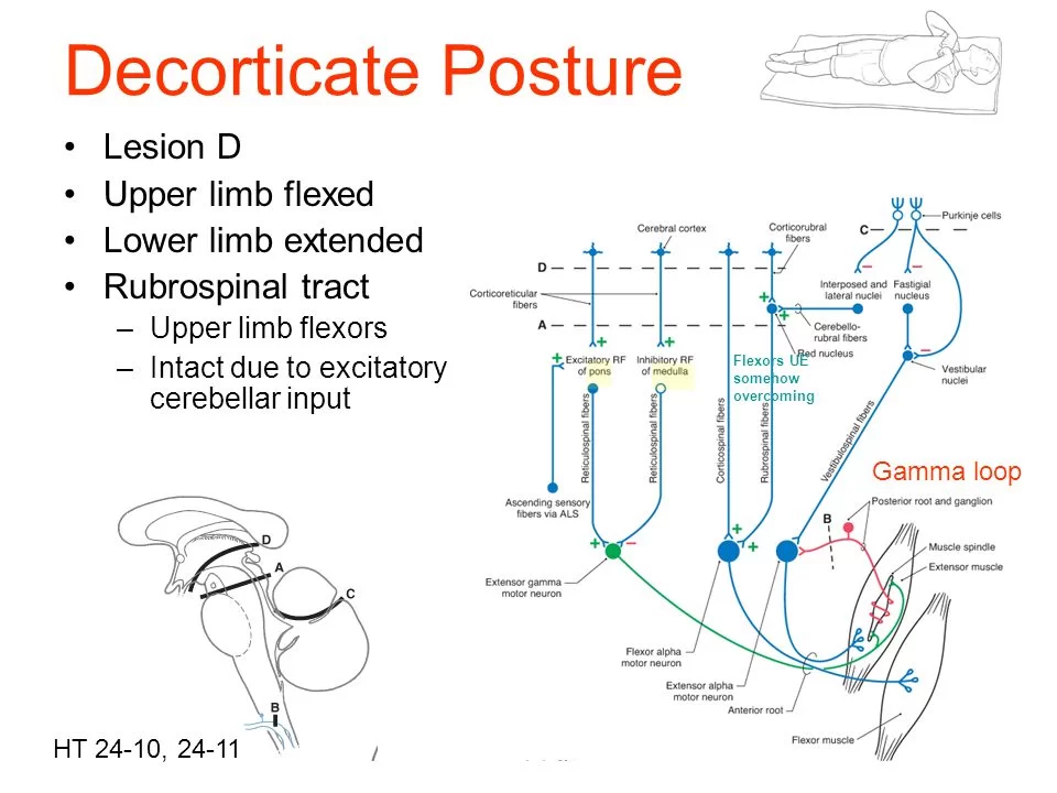 Decorticate Rubrospinal tract