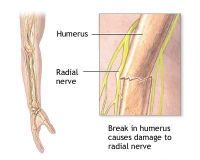 Injury of radial nerve
