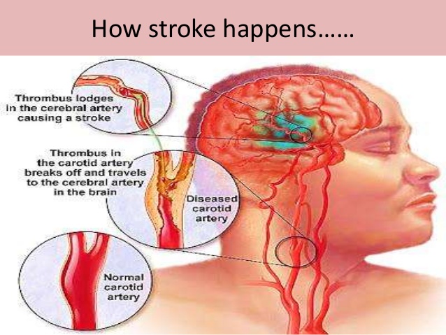 what are the after effects of having a stroke