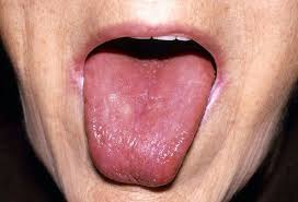 swollen, smooth ,red tongue
