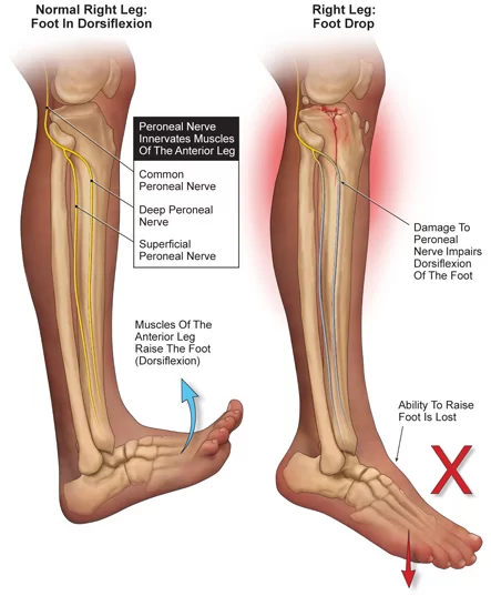 Foot Drop by Common Peroneal Nerve Injury