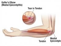 Golfer’s elbow or Medial Epicondylitis