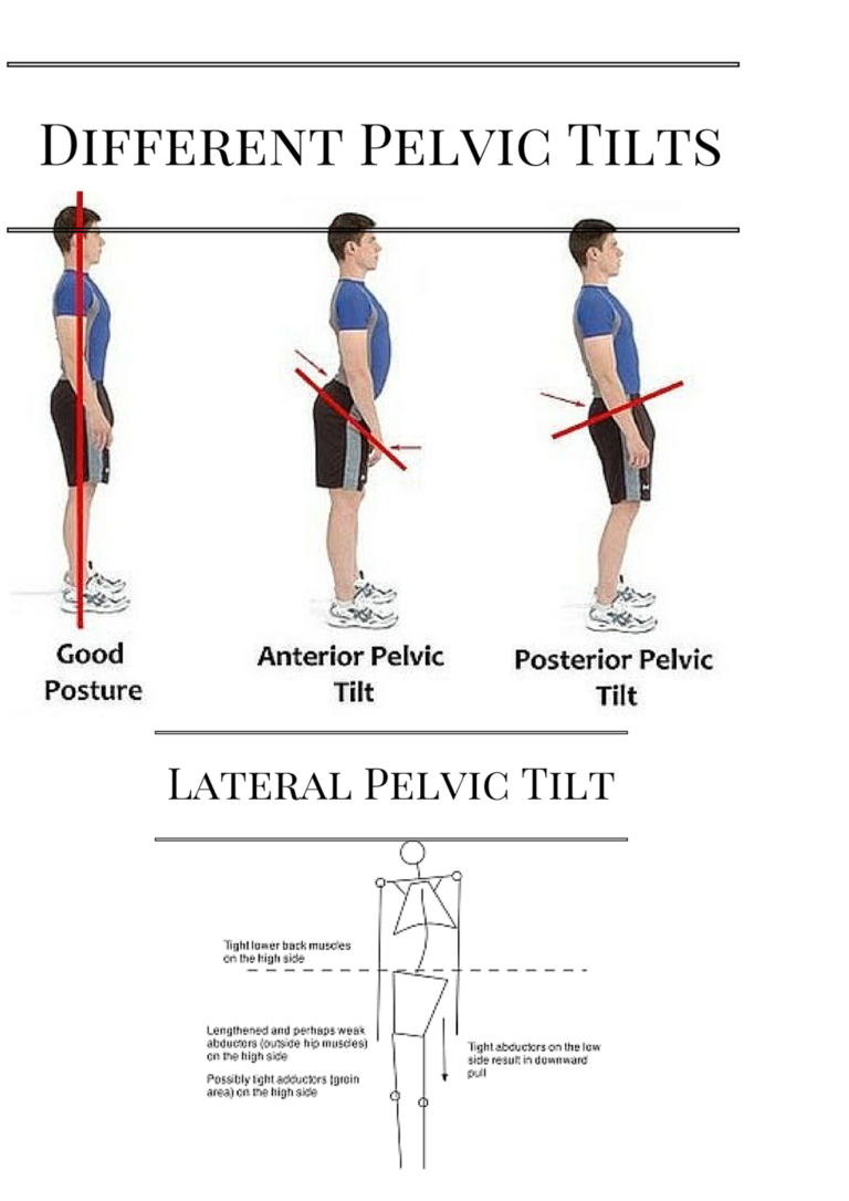 Posterior Pelvic Tilt : Cause, Symptom, Treatment, Physiotherapy Exercise