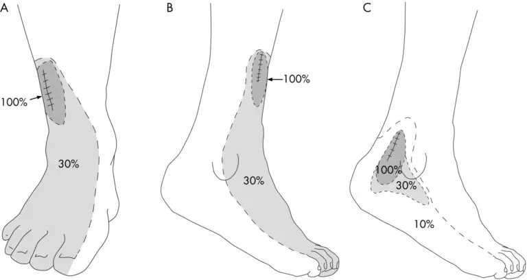 Sensory Distribution of Sural Nerve