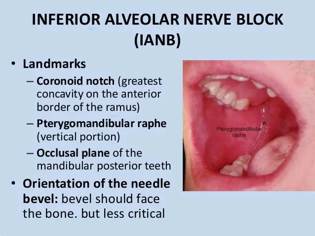Inferior Alveolar Nerve Block